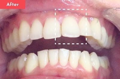 Case 03 After