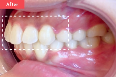 出っ歯治療後 - Oh my teeth マウスピース矯正Proプラン5ヶ月の症例 Case 06