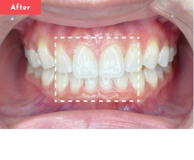 すきっ歯治療前 - Oh my teeth マウスピース矯正Basicプラン症例 Case 27
