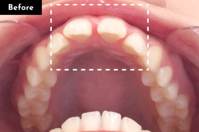すきっ歯治療前 - Oh my teeth マウスピース矯正Basicプラン症例 Case 29